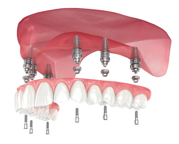 3D Illustration of Implant Supportable Dentures