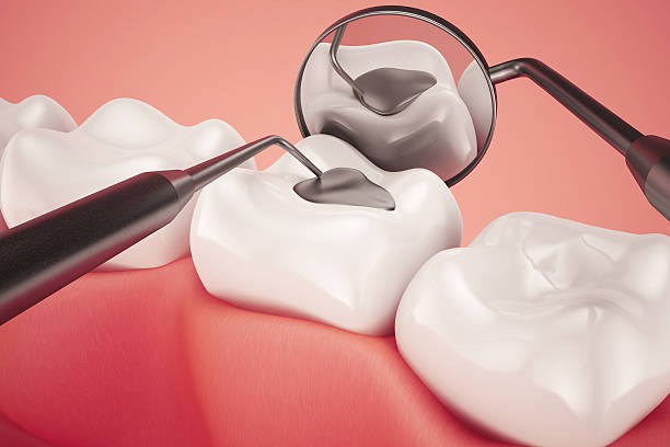Got A Bad Filling? Amalgam Removal in Vancouver