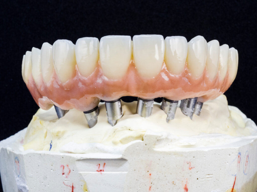 zirconia full-arch dental implants in Vancouver