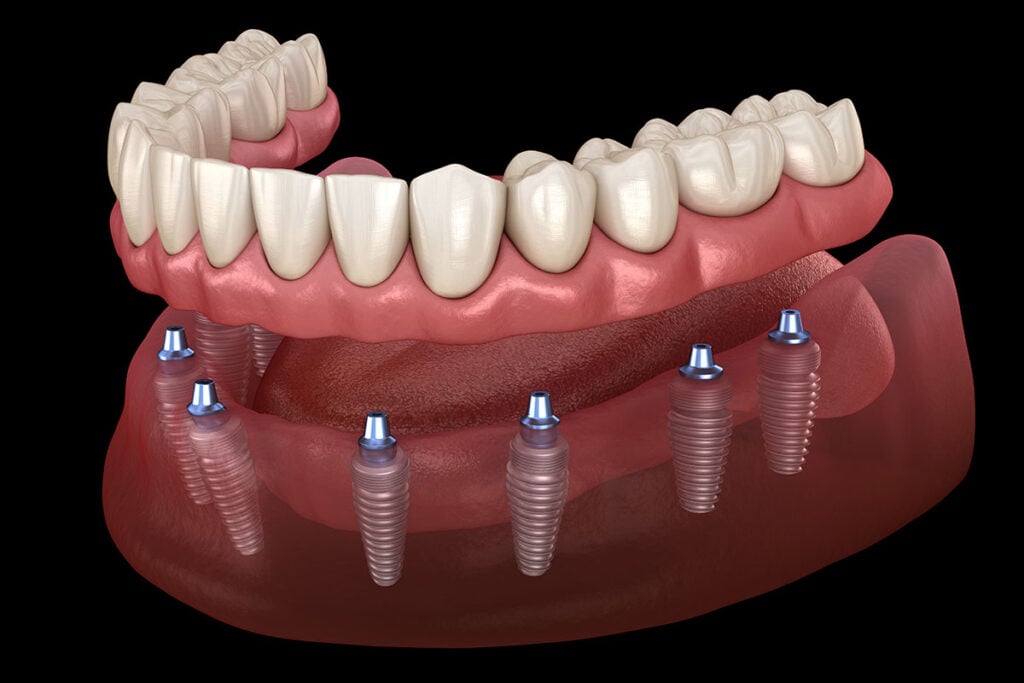 full-arch dental implants in Vancouver WA
