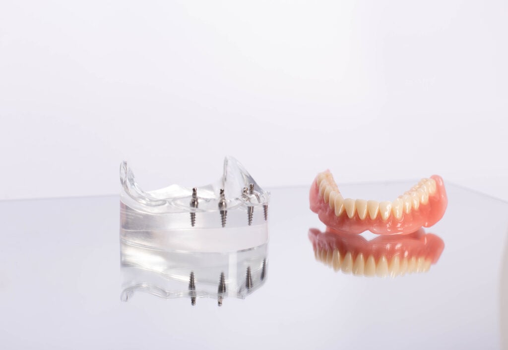 removable implant dentures Vancouver WA
