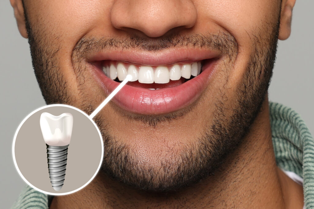 guided implant surgery implants Vancouver, WA