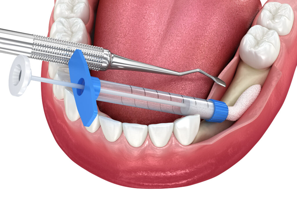 bone grafting, dental implants Vancouver