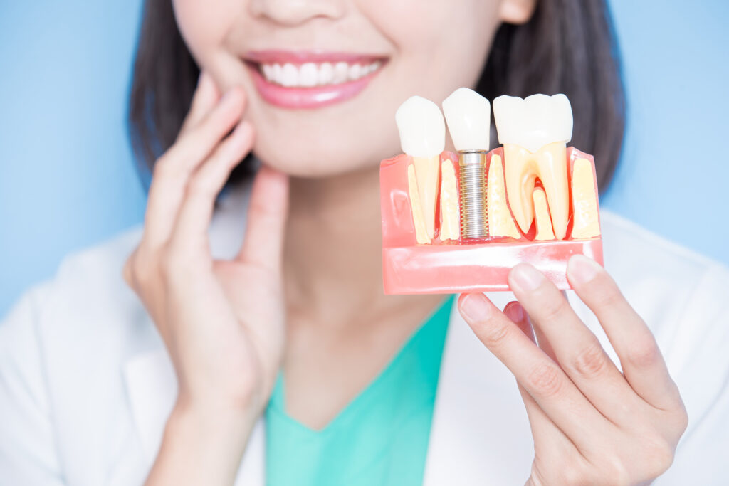 immediate dental implants Vancouver