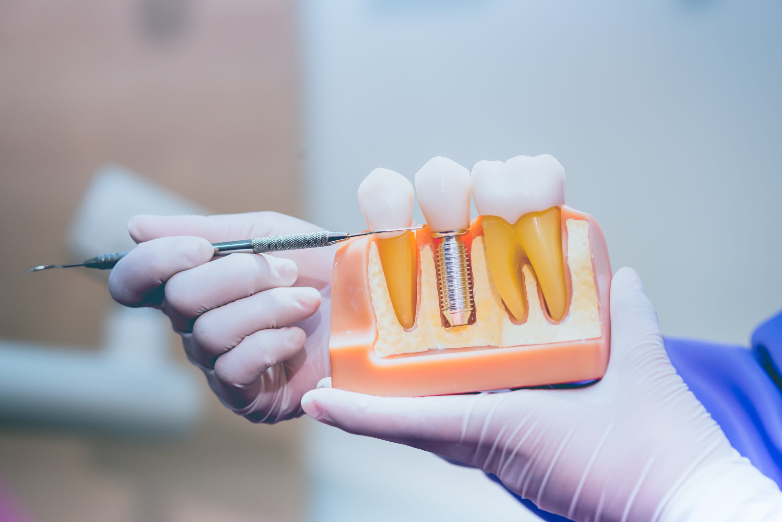 Vancouver dental implants