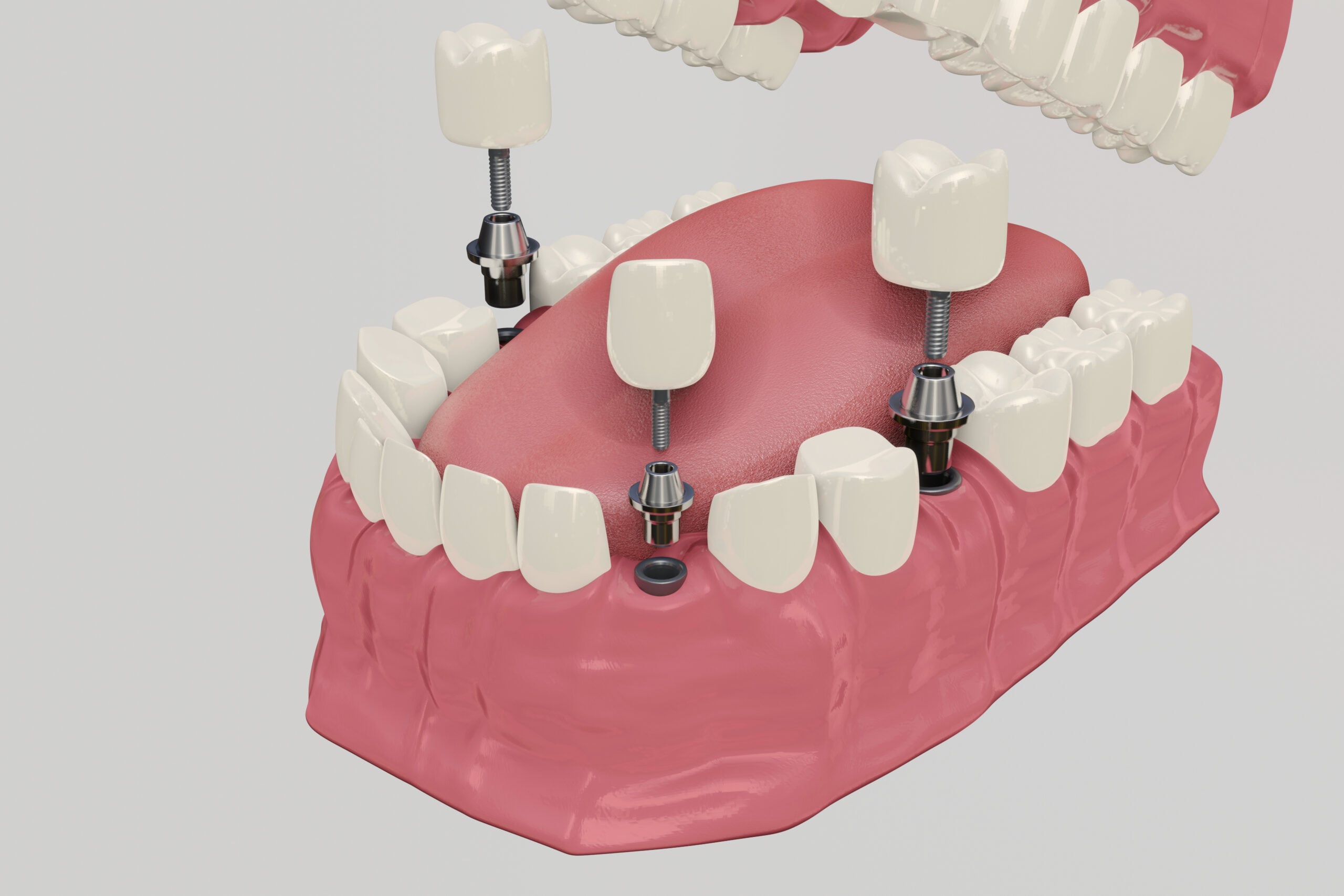 multiple missing teeth solution