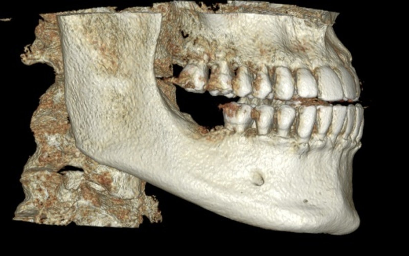 Three-dimensional CBCT reconstruction of a patient's jaw and teeth viewed from the side.