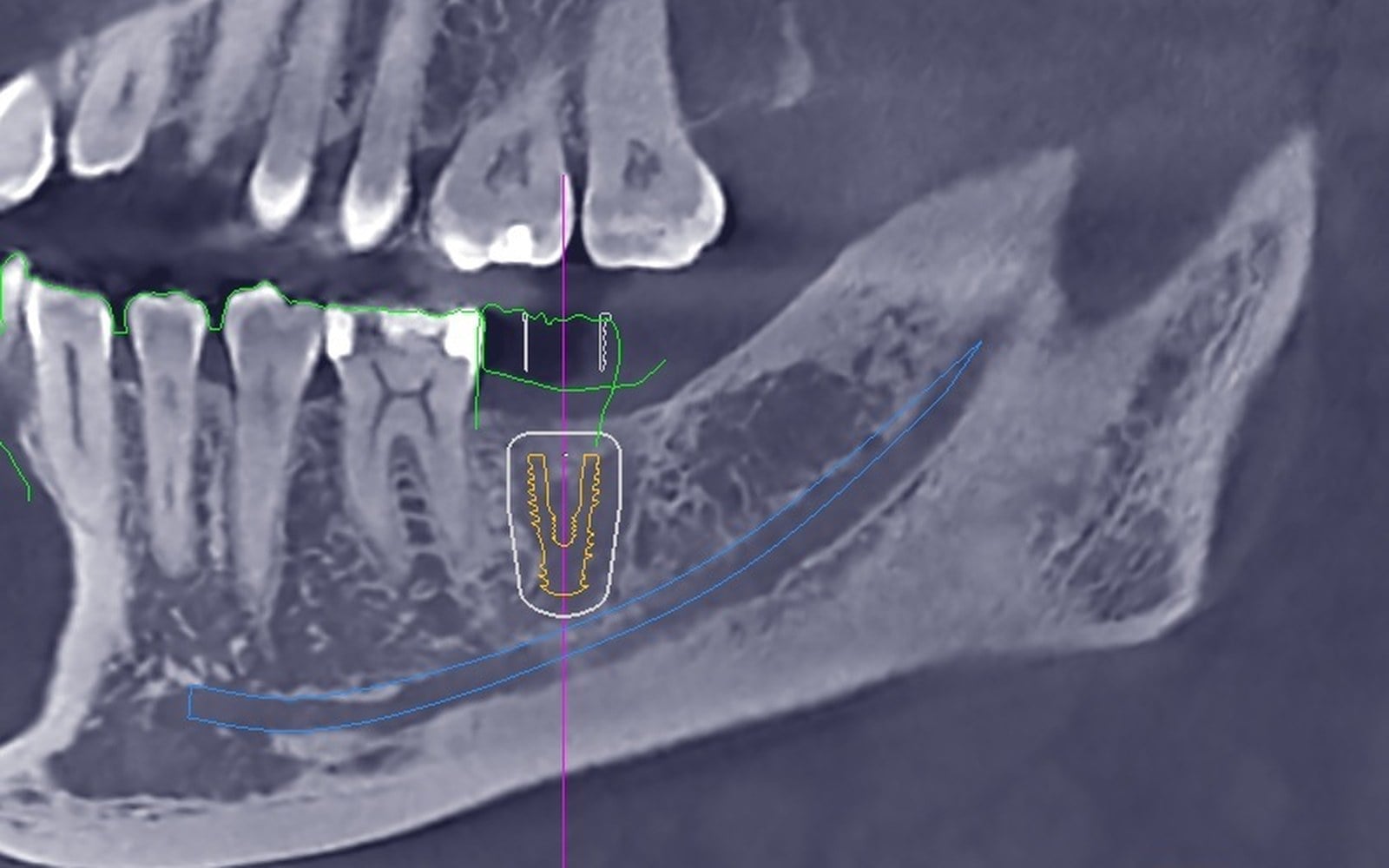 CBCT image of the lower jaw with the nerve canal traced in blue and a planned implant outlined above it.