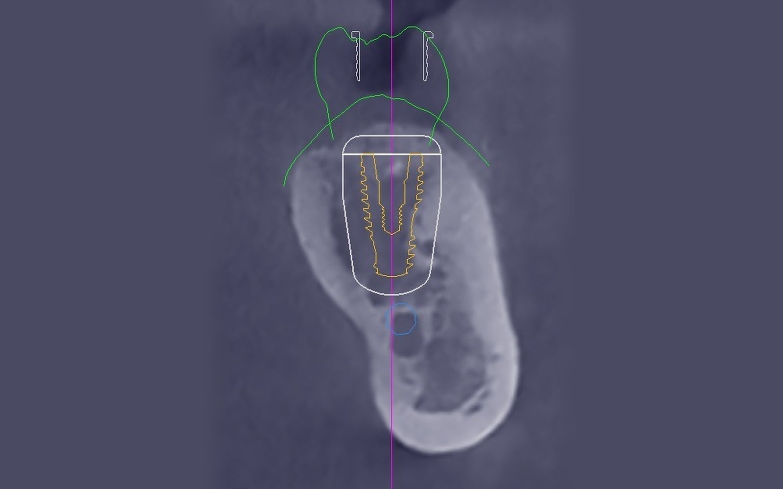 Cross-sectional CBCT slice showing a planned implant centered within the jawbone, with the planned crown outlined above and the nerve canal below.
