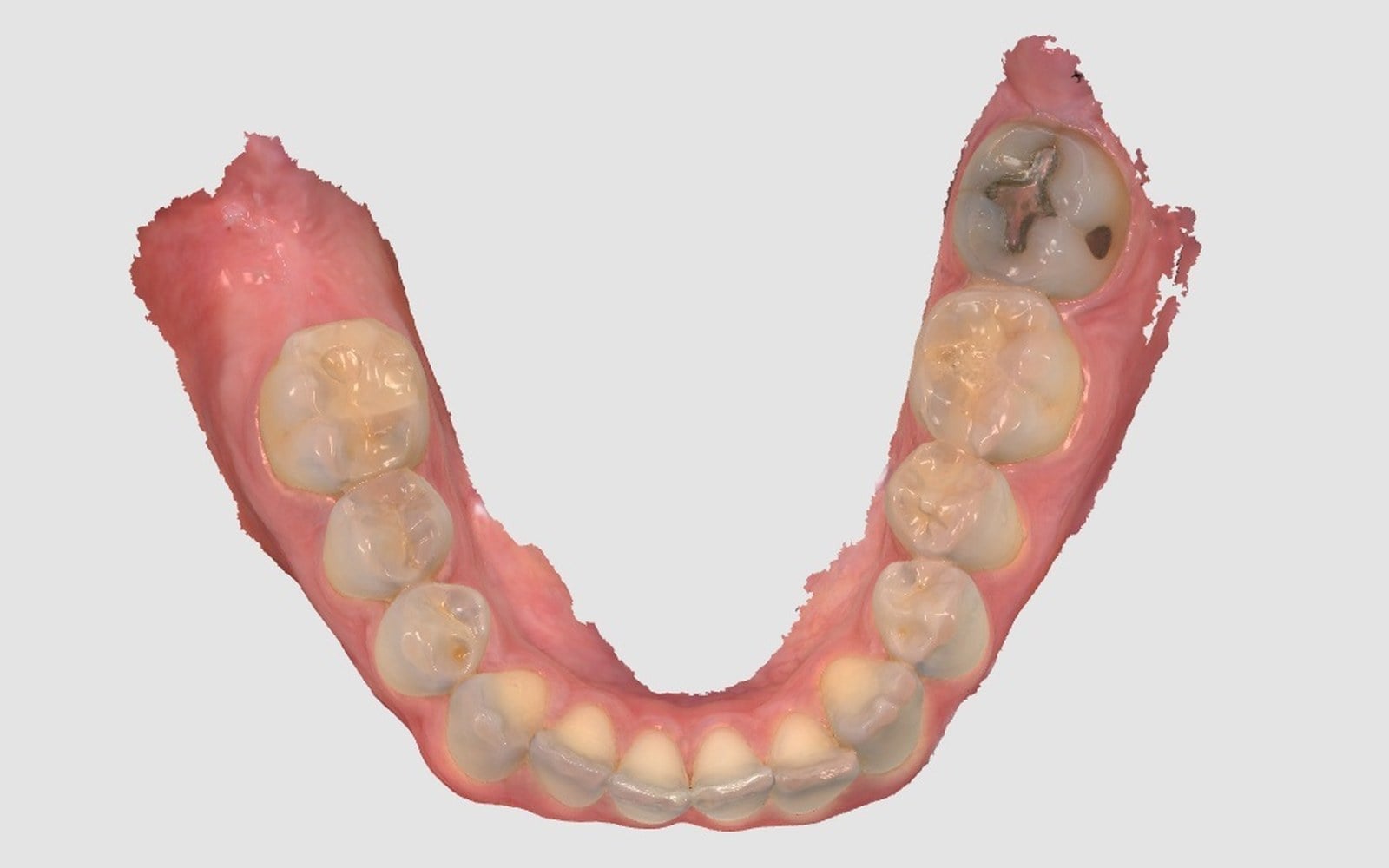 Color digital intraoral scan of the lower dental arch viewed from above.