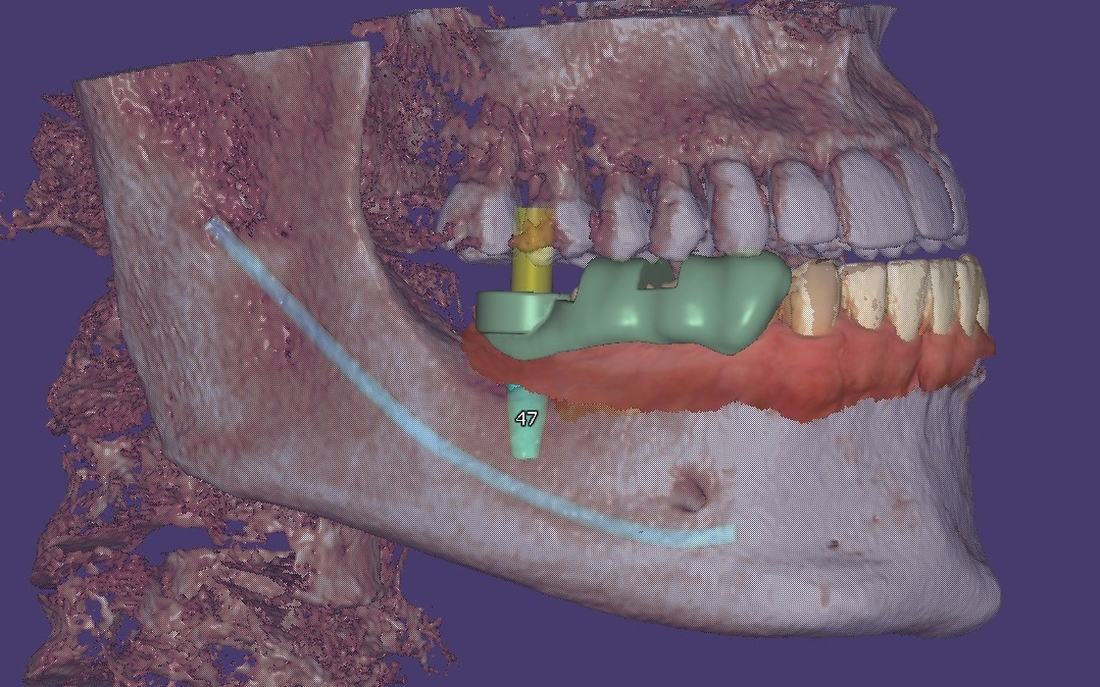Planning software showing a green surgical guide designed over the teeth on a 3D model of the jaw, with the guide sleeve and nerve visible.