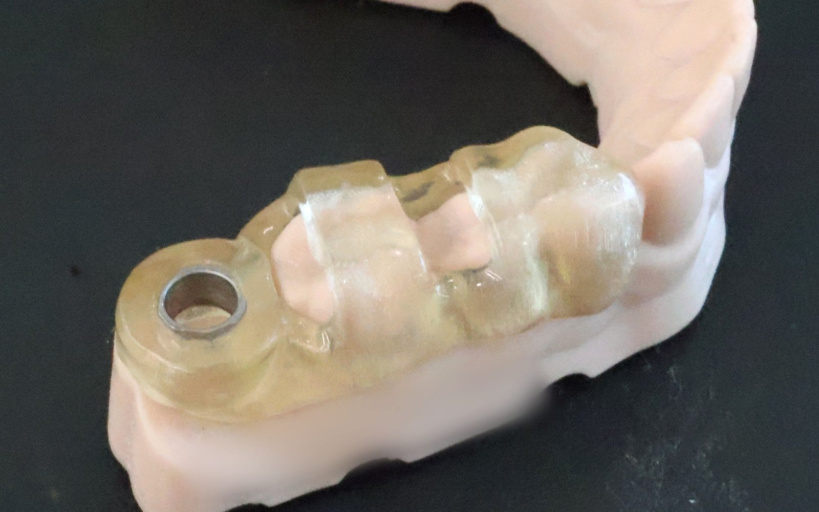 Surgical guide seated on a 3D-printed model of the patient's lower teeth.